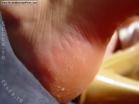 Scandinavian Feet